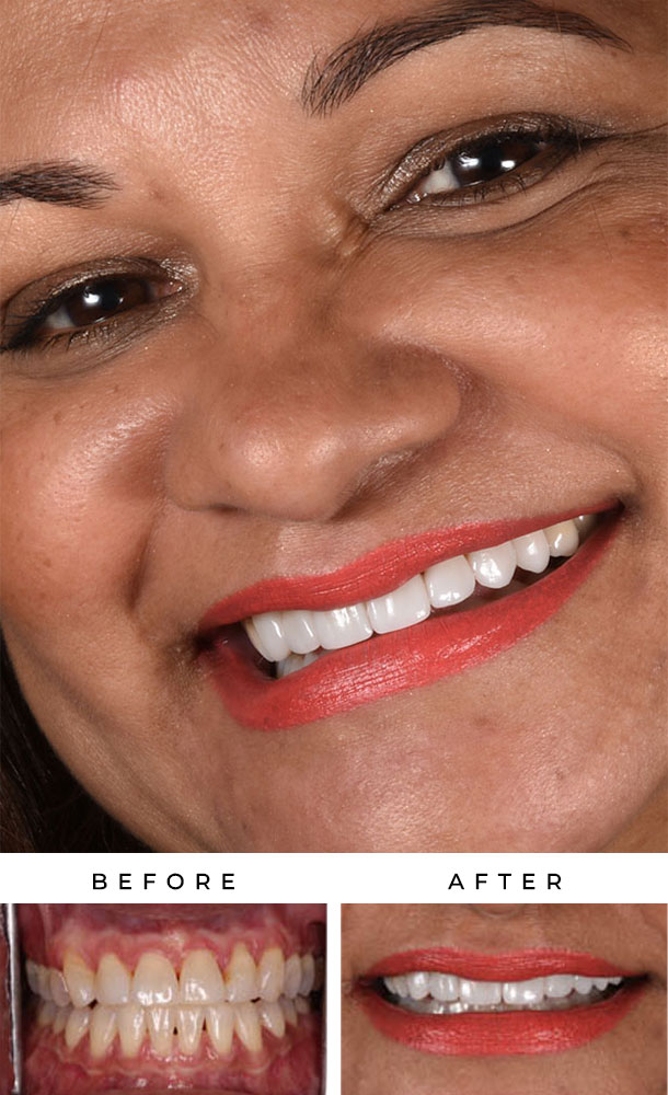 silfa-before-and-after-case-6