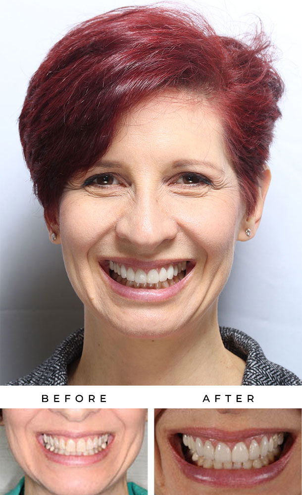 silfa-before-and-after-case-7